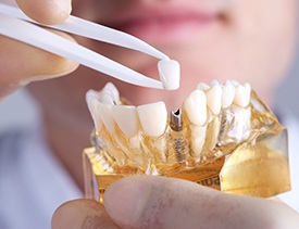 Model of implant-retained dental crown