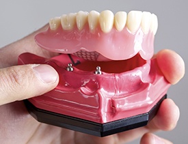 Model of implant supported denture