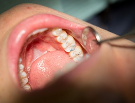 Closeup of teeth examined after filling placement